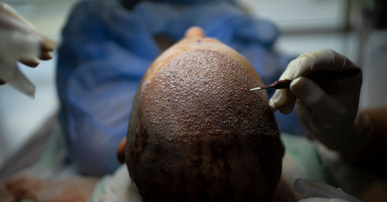 Turquie : comment des médecins ont monopolisé les greffes de cheveux